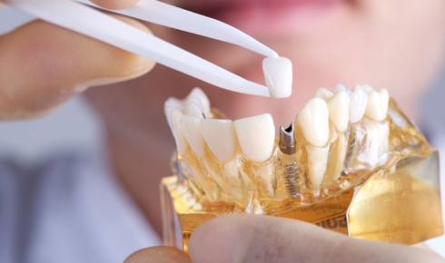 dental implant Melbourne
