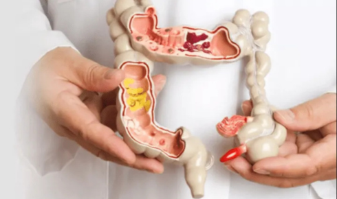 colorectal disease treatment